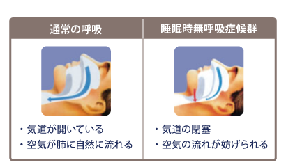 睡眠時無呼吸症候群とは