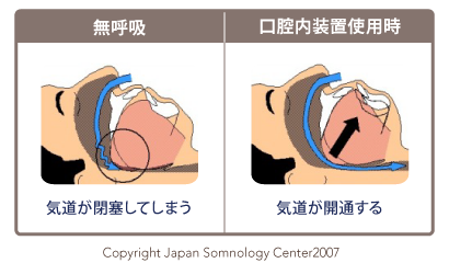 睡眠時無呼吸症候群とは